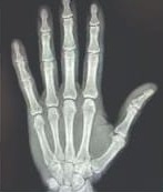 Radiografía de mano