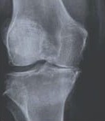 Radiografía de rodilla